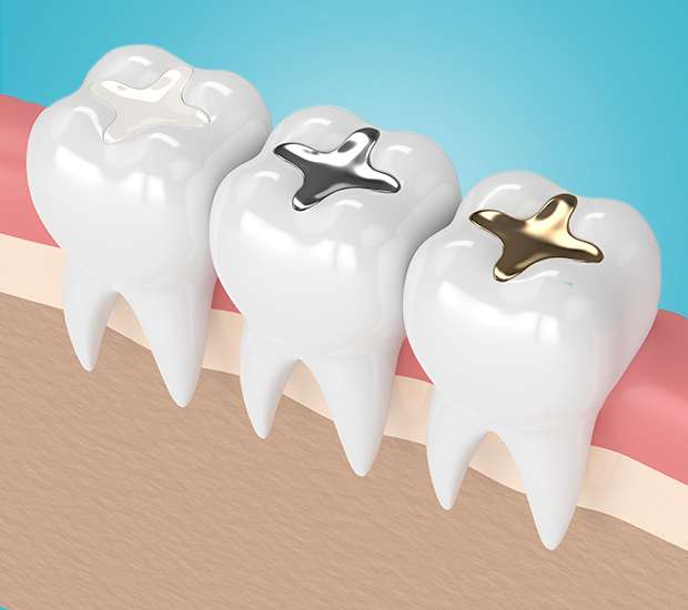 Anderson Composite Fillings