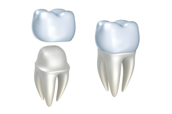 Dental Crowns: How Long Do They Last?