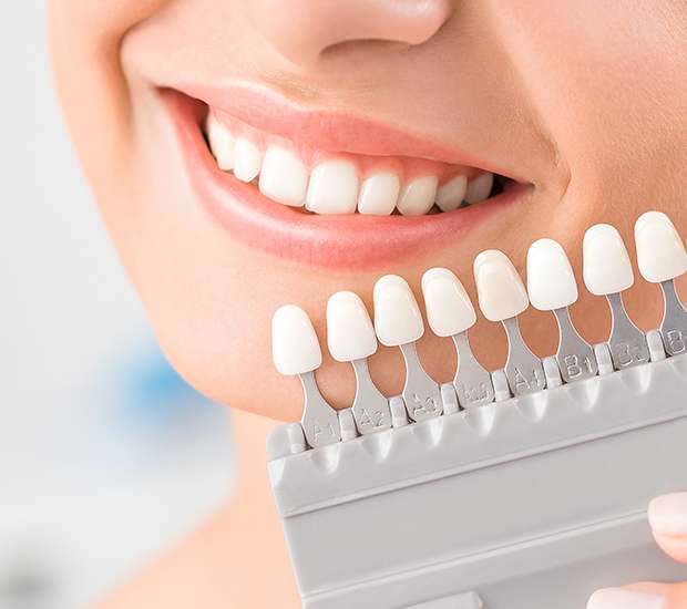 Anderson Dental Veneers and Dental Laminates