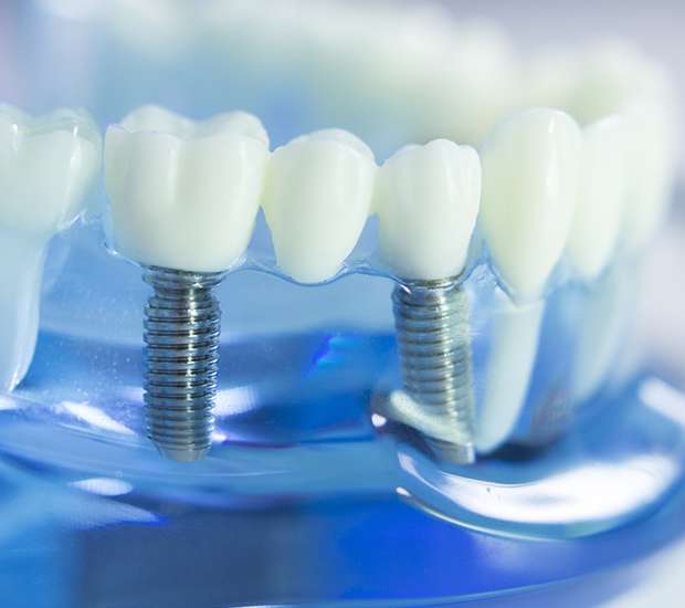 Anderson Dental Implants